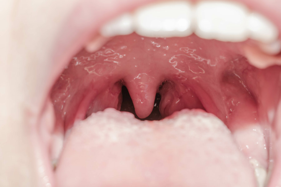 What Is The Incubation Period For Strep Throat Contagious?